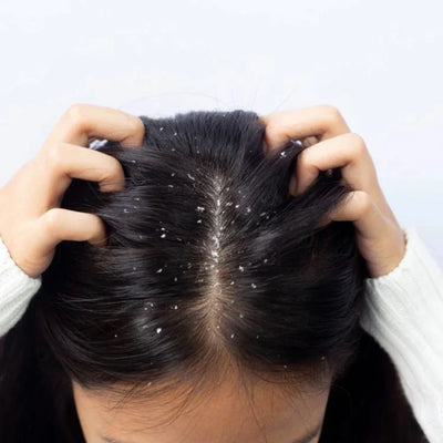 Parnik Naturals Herbal Anti-Dandruff Shampoo + Spray | Complete 2-Step Scalp & Hair Care Solution